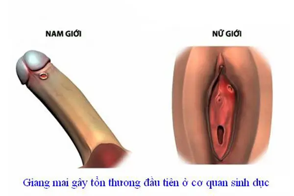 Thân dương vật nổi mụn do bệnh giang mai